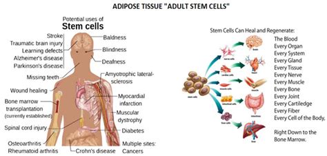 STEM CELL THERAPY — Holland Stem Cells