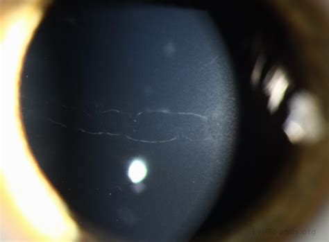 Posterior Polymorphous Corneal Dystrophy (PPMD)