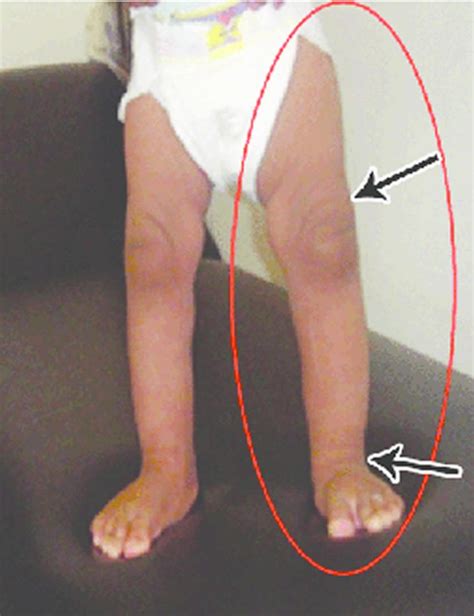 Hemihyperplasia definition, causes, symptoms, diagnosis & treatment