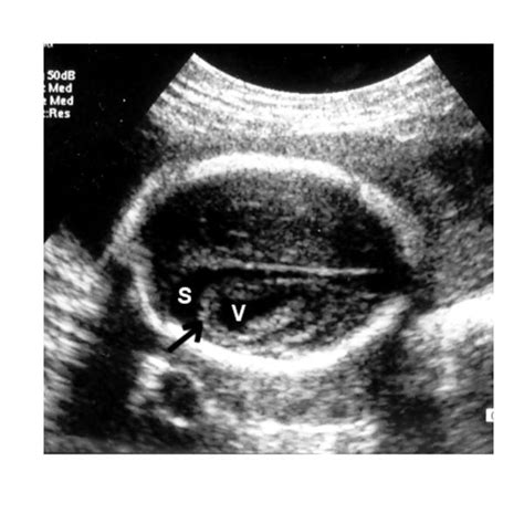 Severe microcephaly with associated brain atrophy at 24 weeks. The... | Download Scientific Diagram