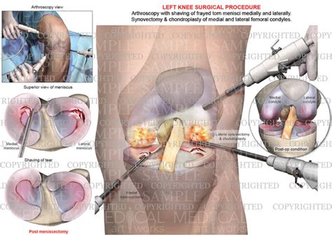 Left Knee Arthroscopy - Medial & Lateral Meniscectomy - Chondroplasty - Synovectomy — Medical ...