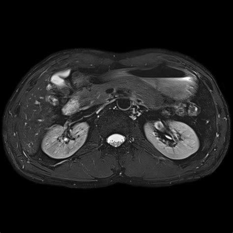 3 Tesla MRI Magnetic Resonance Imaging — North Country Neurology PC