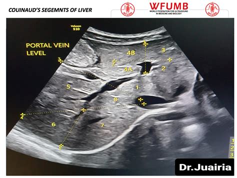 Ultrasound the Best #17: Segments of Liver – WFUMB