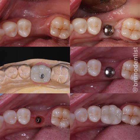 Replacing missing molar tooth with dental implant and zirconia crown #zirconiacrown # ...