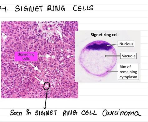 Signet Ring Cells - MEDizzy