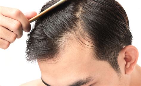 What is PRP Injection for Hair Loss? - Vargas Face and Skin Center