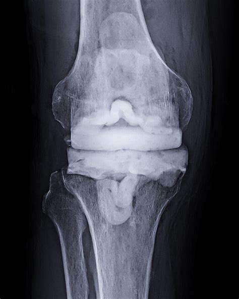 Infected Knee Replacement – ADAM SASSOON M.D., M.S.