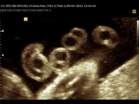 Single umbilical artery ultrasound - YouTube