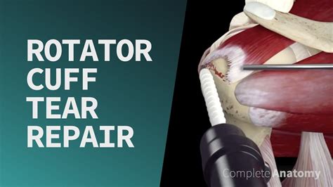 Rotator Cuff Tear Repair - YouTube