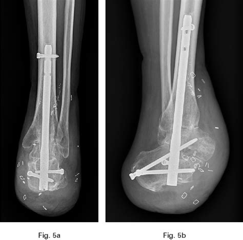 Figure 5 from Chopart amputation with tibiotalocalcaneal arthrodesis and free flap ...