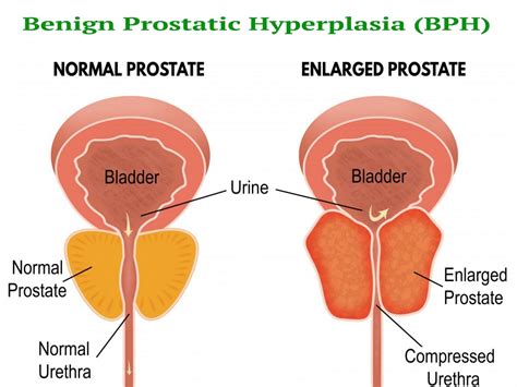 Benign Prostatic Hyperplasia