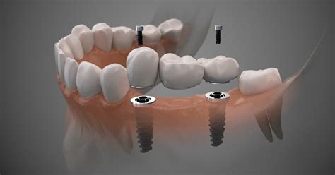 Digital Implant Workflow will Change your Surgery Experience | NSOMS (Oral & Maxillofacial Surgeons)