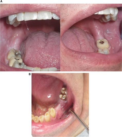 a BARK on the retromolar pad, present bilaterally. Note the bite ...