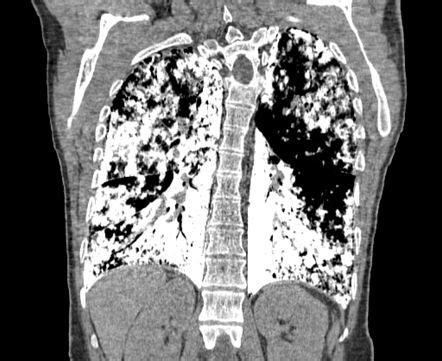 Pulmonary alveolar microlithiasis | Radiology Case | Radiopaedia.org | Radiology, Pulmonary ...