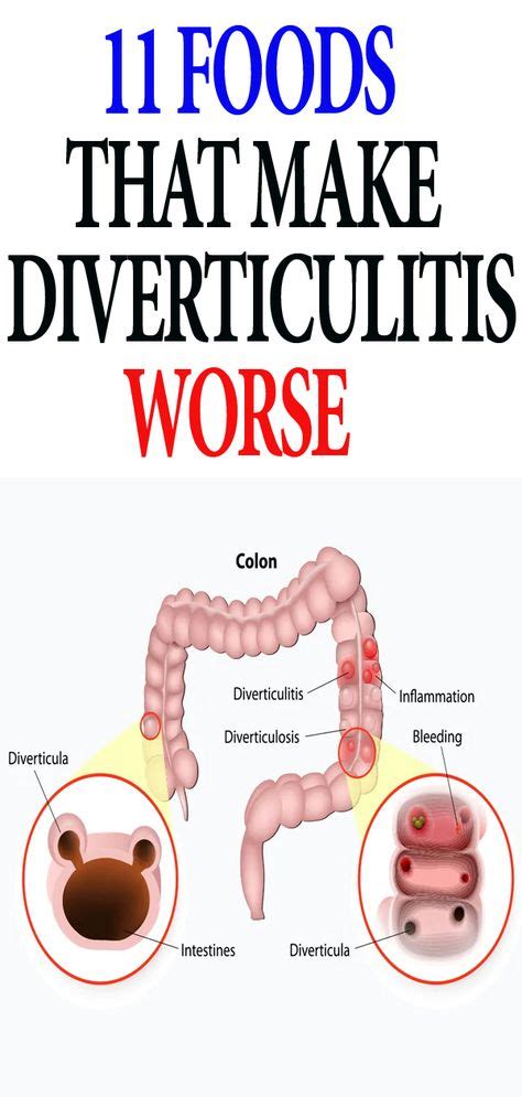 24 Diverticular Disease ideas | diverticulitis diet, diverticulitis, diverticulosis diet