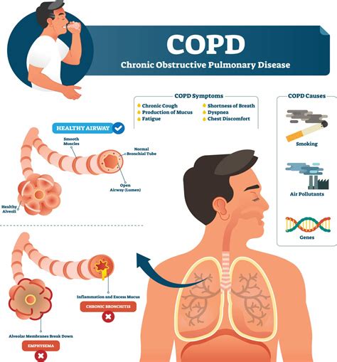 Chronic Obstructive Pulmonary Disease | COPD Treatment London