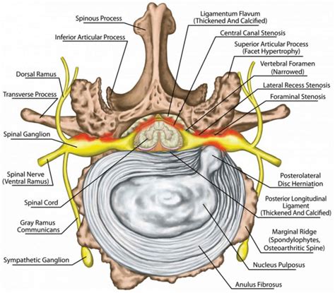 Neural foraminal stenosis causes, symptoms, diagnosis, treatment ...