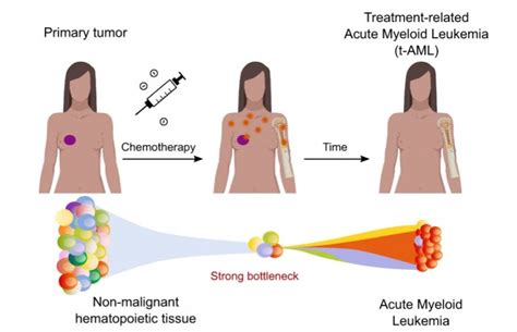 Leukemia Treatment Chemotherapy