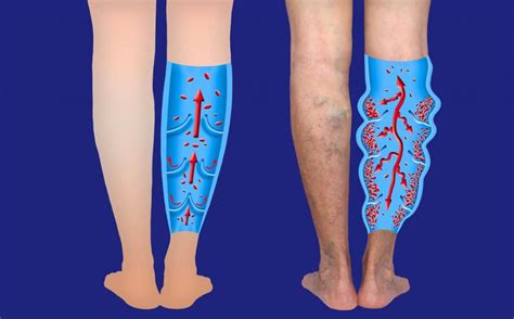 Venous Insufficiency and The Main Causes