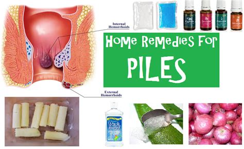 Best Home Remedies for Piles | Home remedies for hemorrhoids, Home remedies, Hemorrhoid remedies