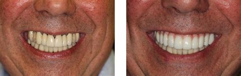 Before & After | NYC Dental Implants | Manhattan NY