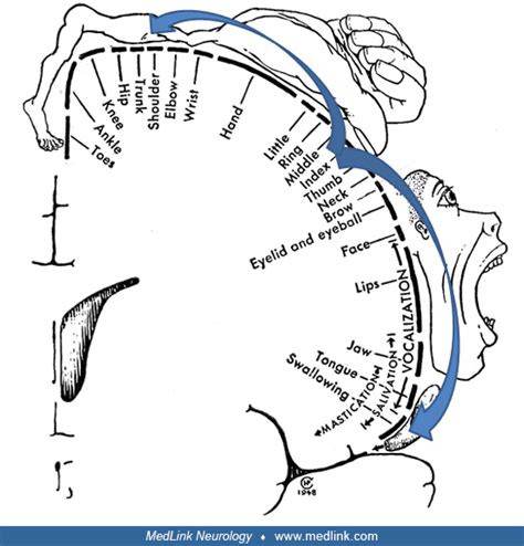 Jacksonian seizures | MedLink Neurology