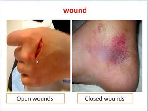 wounds- part1 - YouTube