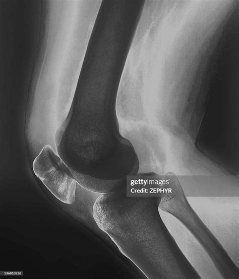 Broken Knee Xray High-Res Stock Photo - Getty Images