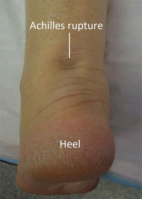 Achilles Tendon Rupture | Dr Ben Beamond | Adelaide