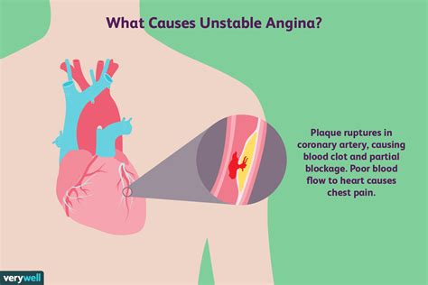 ¿Qué es la angina inestable? - Medicina Básica