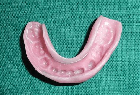 Fabricated occlusal splint | Download Scientific Diagram