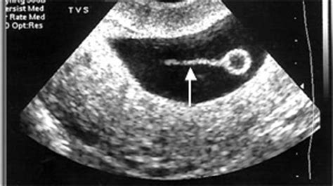 Vitelline Duct Ultrasound