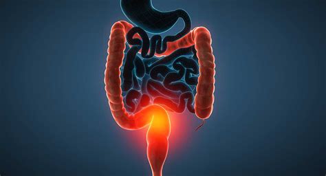 Ulcerative Colitis (UC) - Dr Sandra Cabot MD