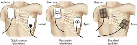 funest Poate Obraznic aed pad placement secol Bebelus alege