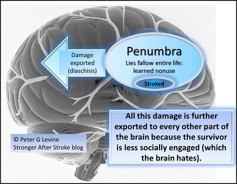 Stronger After Stroke Blog (THE STROKE RECOVERY BLOG)