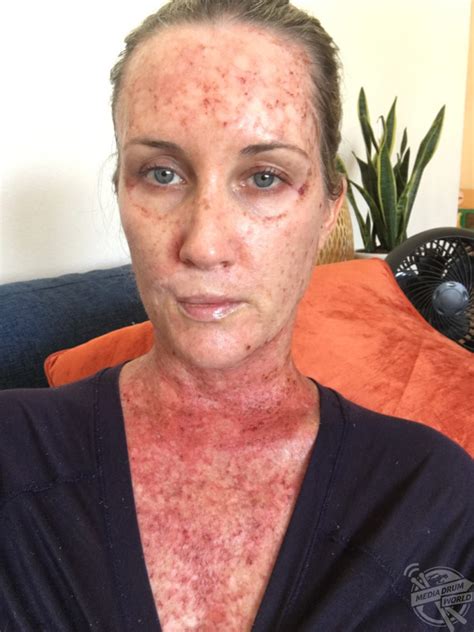 What This Woman Thought Was A Spot Turned Into A Fight With Skin Cancer ...