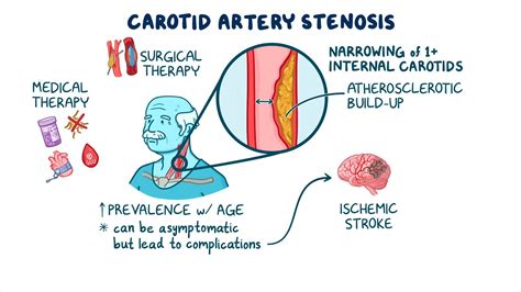 Carotid artery stenosis screening: Clinical sciences - Osmosis Video Library
