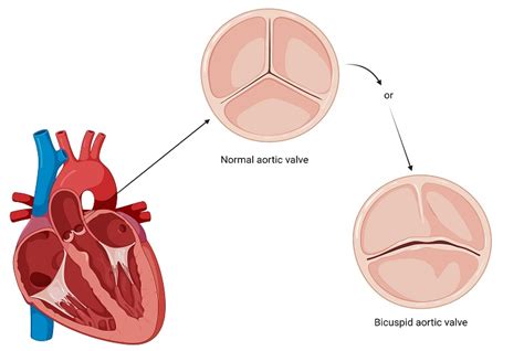 Bicuspid Aortic Valve | VCU Health