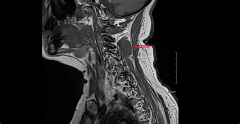 Irresti: Cortical Desmoid Ct