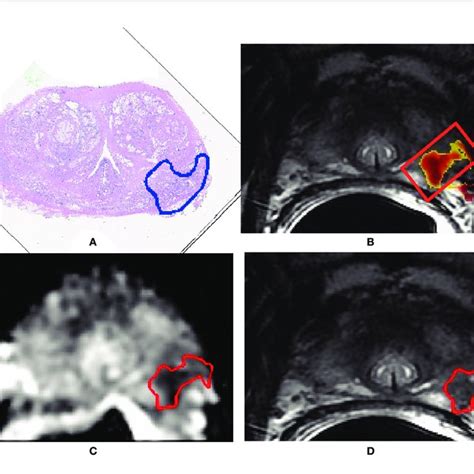 | A 71-year-old man with Gleason score 3 + 4 (GG 2) prostate cancer ...