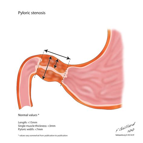 Pyloric stenosis - diagram | Radiology Case | Radiopaedia.org Pediatric ...