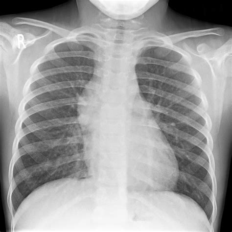 Acute lymphoblastic leukemia chest x ray - wikidoc