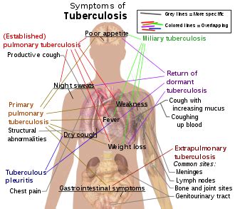 Tuberculosis - Wikipedia, the free encyclopedia