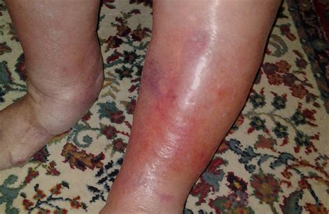 Cellulitis: Causes, Pictures & Treatment