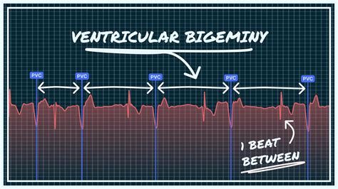 What Ventricular Bigeminy Looks Like on Your Watch ECG | Qaly