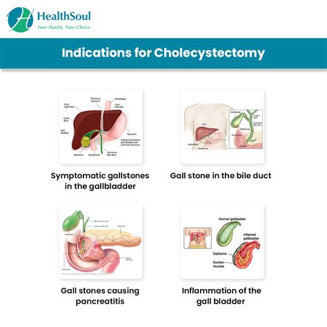 Cholecystectomy: Indications and Risks | General Surgery | HealthSoul