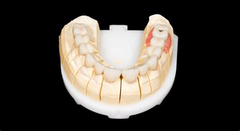 What Is a Zirconia Crown?