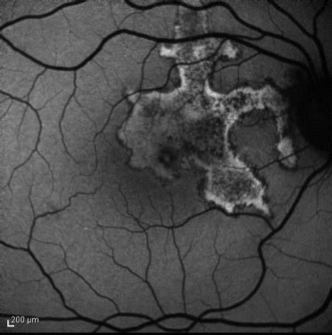 Serpiginous Choroiditis - Retina Image Bank