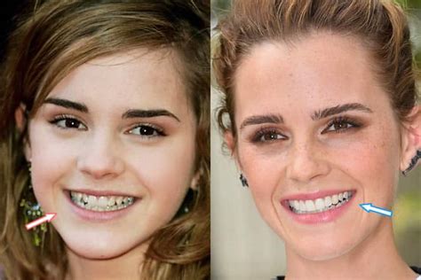 Emma Watson Cosmetic Surgery - Nose Job, Teeth & Breast Implants?