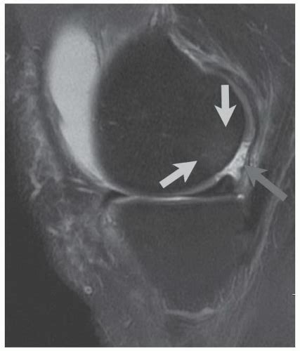 Microfracture Chondroplasty | Musculoskeletal Key